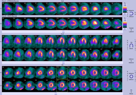 A normal nuclear cardiac study