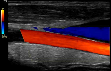 Color Doppler ultrasound image of the carotid artery