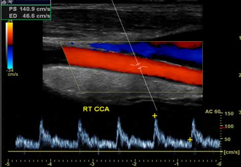  Imagen de ultrasonido Doppler de la arteria carótida