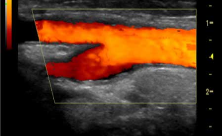 Imagen de ultrasonido Power Doppler de la arteria carótida