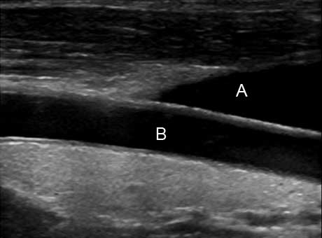 An image of the carotid artery
