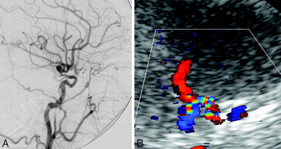 X-ray and ultrasound images showing narrowing of the carotid artery.