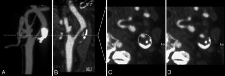 Angiografía por tomografía computarizada (CTA) que muestra estenosis de la arteria carótida.  