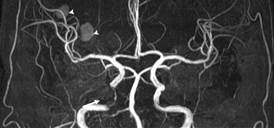 MR angiogram of a patient with stenosis of the internal carotid artery .