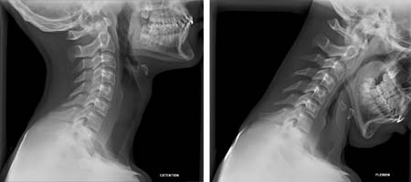  Vistas de rayos X de la columna cervical