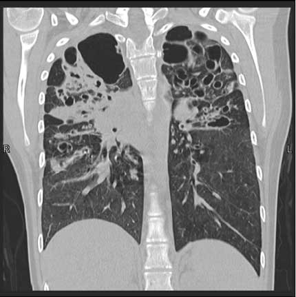  Tomografía computarizada que muestra fibrosis quística.