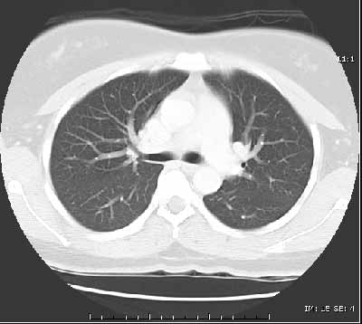  Imagen de TC de los pulmones