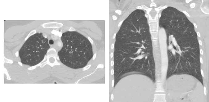 CT images of the chest.