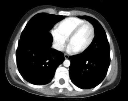 A normal chest CT scan of a young boy