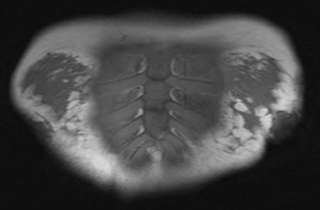 Resonancia magnética del esternón, las costillas y partes de ambos senos