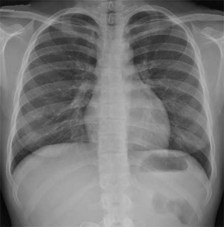 A normal female chest x-ray 