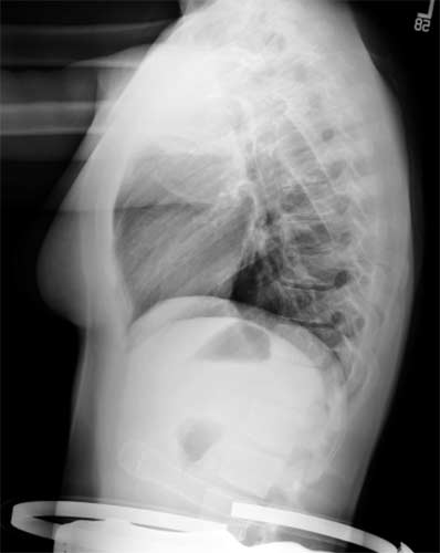  Una radiografía de tórax femenina normal