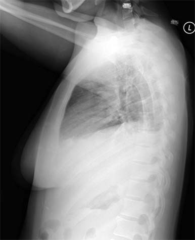 Chest x-ray of a patient with pneumonia