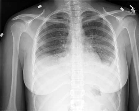 Radiografía de tórax de una paciente con neumonía