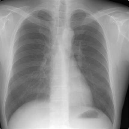 Chest x-ray