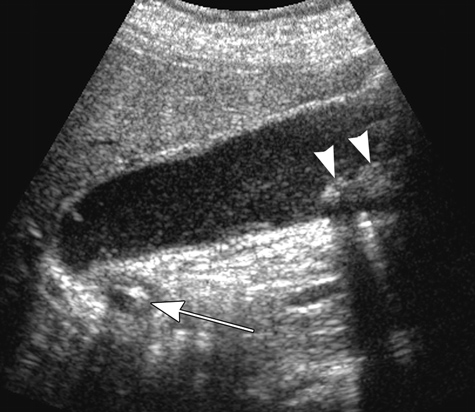 Imagen de ultrasonido que muestra colecistitis aguda.