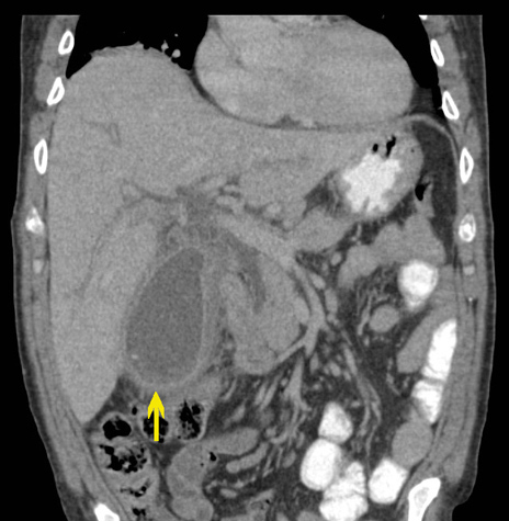 CT image showing acute cholecystitis.