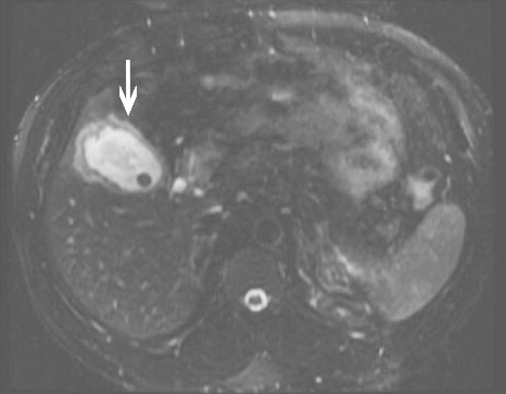 MRI showing chronic cholecystitis.