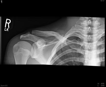 Shoulder x-ray showing a fractured clavicular bone