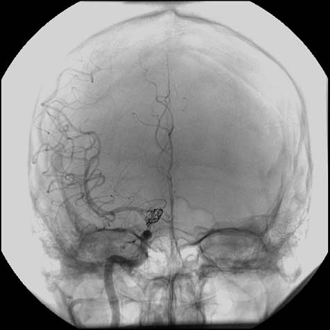 Angiograma de una aneurisma arterial después de embolización por espiral.