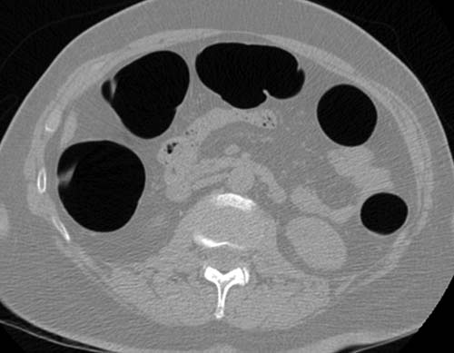 CT colonography image