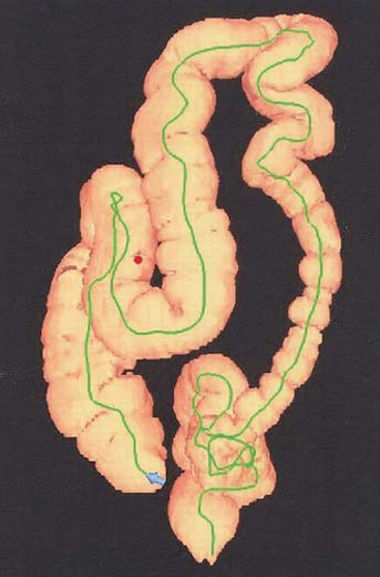 Mapa esquemático del colon generado con un software de colonografía por TAC. 