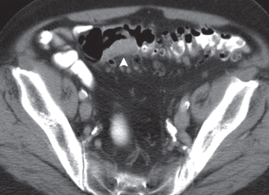 Imagen de TAC del colon que muestra una gran masa.  
