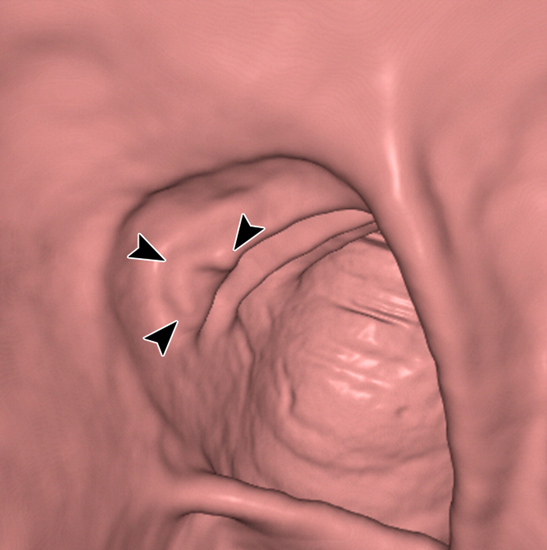  3-D virtual colonoscopy showing a lesion.