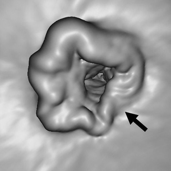 Imagen de una colonografía por TAC mostrando una masa rectal.