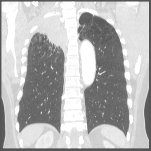 Imágen por TAC de un tumor RUL Pancoast.