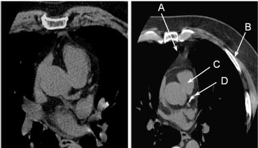 CT image of a normal coronary artery.