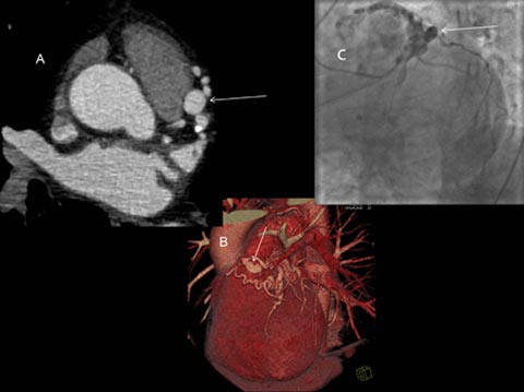 Coronary artery aneurysms