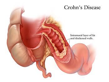 Illustration of Crohn's disease