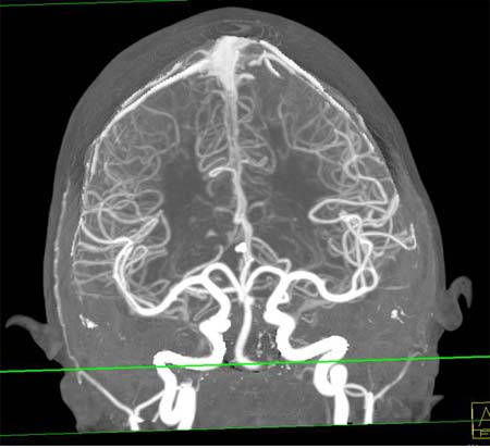 Brain CTA image
