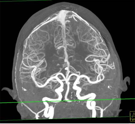  Imagen de CTA cerebral