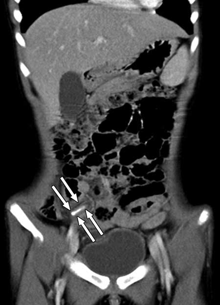 Imagen de TC que muestra apendicitis aguda en un niño.