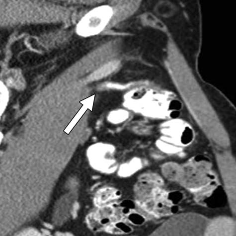 Imagen de TC con contraste en pacientes con apendicitis aguda.