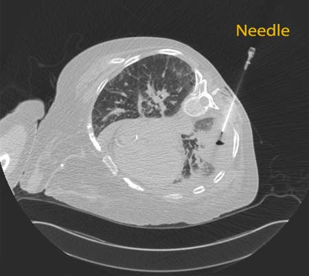 Chest CT scan