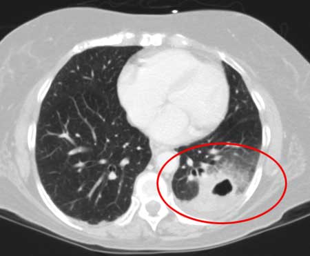 Chest CT scan showing cavitary pneumonia.