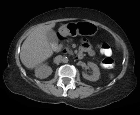 CT image showing gallstones.