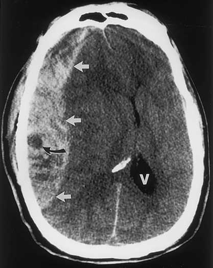 Imagen de CT de la cabeza que muestra un gran coágulo de sangre.