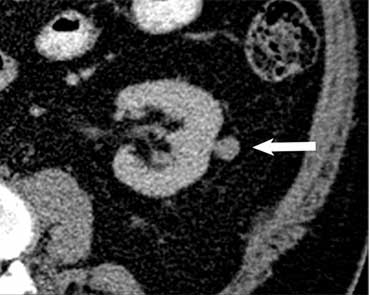  Imagen de TC que muestra una masa renal.