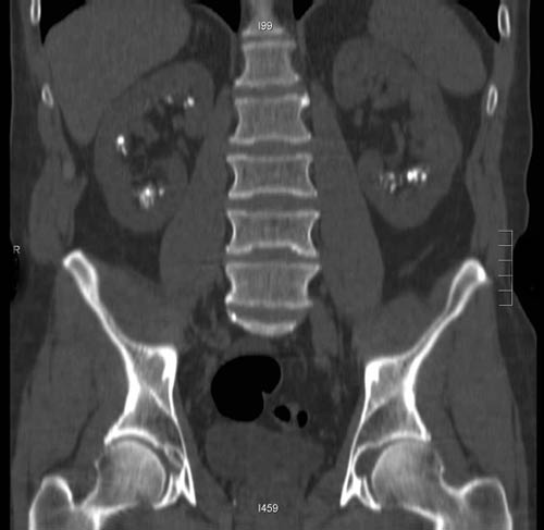 CT image showing kidney stones. 