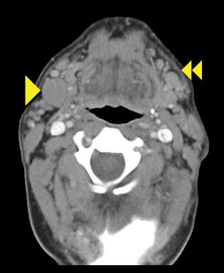 Imagen de tomografía computarizada del cuello que muestra linfoma.