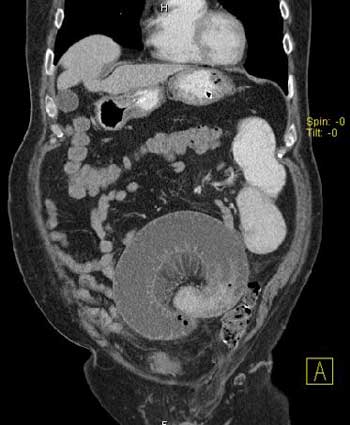 A CT image showing a closed loop small bowel obstruction