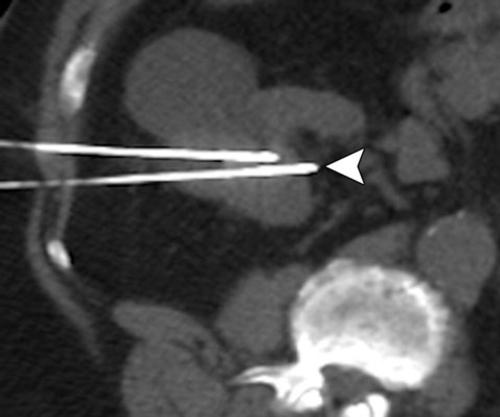 CT image showing microwave applicators.