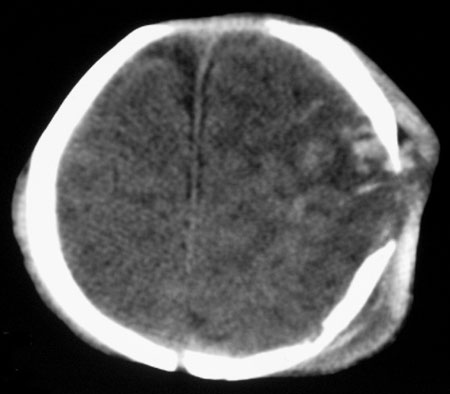 Imagen de CT de la cabeza de un niño que muestra una fractura de cráneo. 
