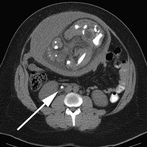  Imagen axial de CT de un examen de riñón en una paciente embarazada.