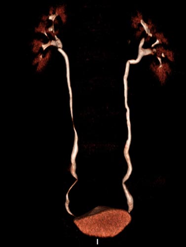 Una imagen de imagen 3D-CT del abdomen y la pelvis