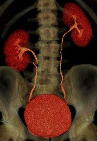 3D three-phase CT urogram